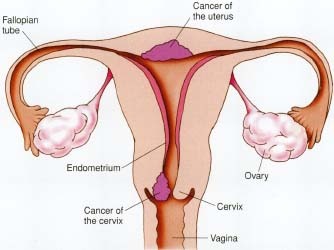 Cancer Cervix